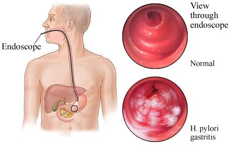 HOW IS H. PYLORI INFECTION DIAGNOSED?