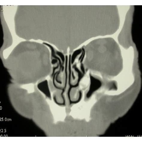 Coronal view of the CT scan of the paranasal sinus showing the osteoma... | Download Scientific ...