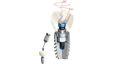 Product Profiles: Integrated restorative systems from Nobel Biocare - Decisions in Dentistry