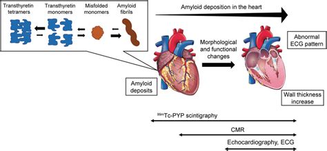 Conceptual diagram for the pathophysiology of transthyretin amyloid ...