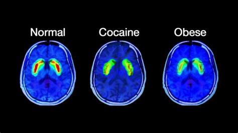 Science Explains What Happens To Your Brain on Sugar | ThatViralFeed