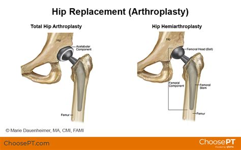 Guide | Physical Therapy Guide to Total Hip Replacement (Arthroplasty ...