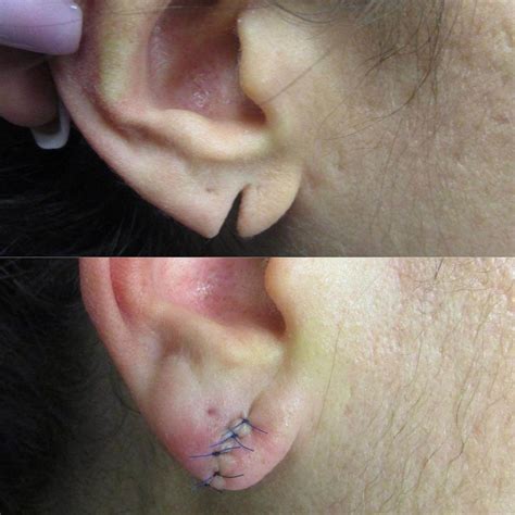 Earlobe Rejuvenation Surgery in NYC and Long Island