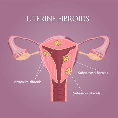 Uterine Fibroids Signs and Symptoms | Treating Uterine Fibroids