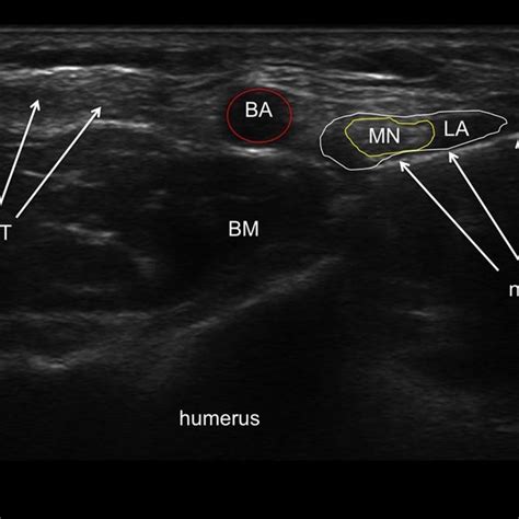 (PDF) Peripheral nerve blocks on the upper extremity