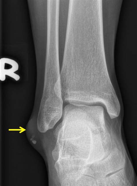 Epidermal cyst at ankle – Radiology Cases