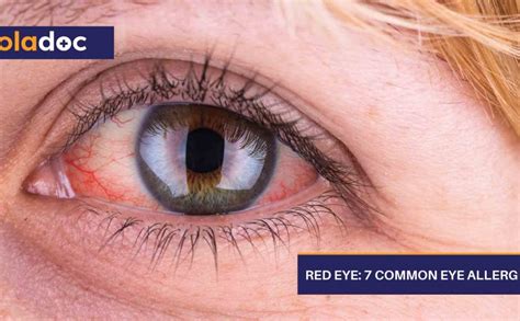 Red Eye: 7 Common Eye Allergies | Eyes and Vision | oladoc.com