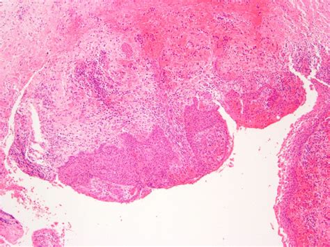 Dentigerous Cyst Histology