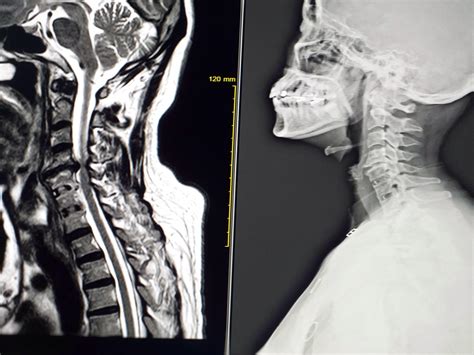 MRI Cervical-spine Shows C4-C5 Moderate spinal cord compression ...