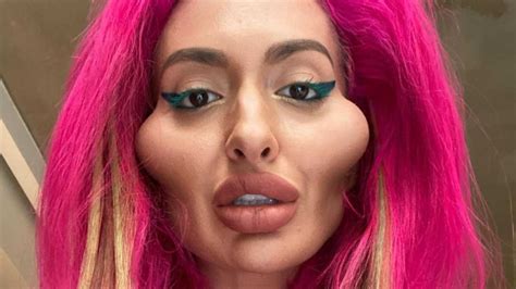 All about IG model who is addicted to cheek fillers & has 'biggest ...