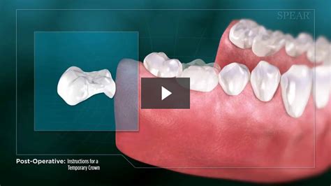 Post-Operative Instructions for a Temporary Crown - Cosmetic Dentistry