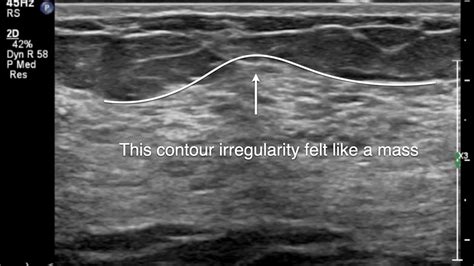 Breast Ultrasound - pronounced glandular tissue - YouTube