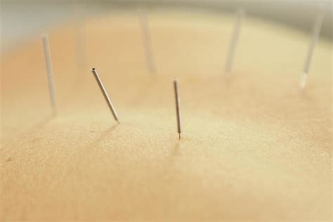 Female back with steel needles during procedure of acupuncture therapy ...