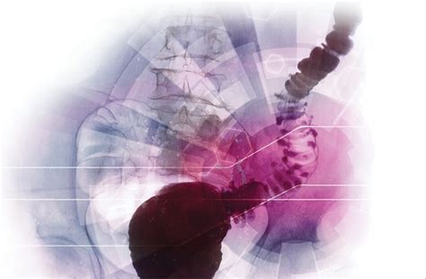 Surgery for Diverticulitis: Who, When and How Still Up for Debate