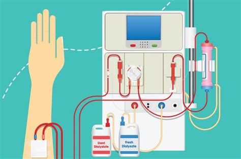 Apakah Cuci Darah Harus Rutin? - Interskala Sehat Sejahtera