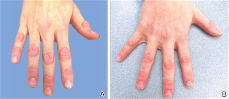 Knuckle Pads Definition Causes Symptoms Diagnosis Tre - vrogue.co