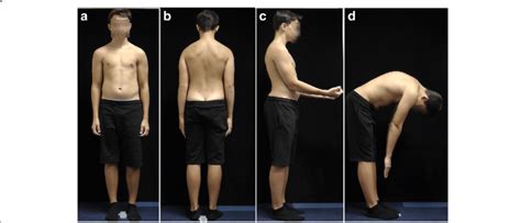 A 14-year-old boy with structural sagittal misalignment of body... | Download Scientific Diagram