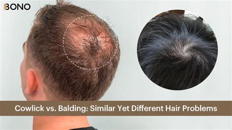 Cowlick vs. Balding: Similar Yet Different Hair Problems