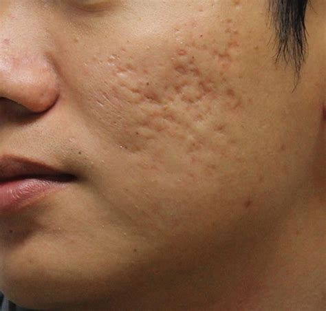 Acne Scar Removal & Treatment Austin, Texas | CTD