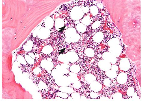 Histopathologic specimen revealed lamellar bone containing mature... | Download Scientific Diagram