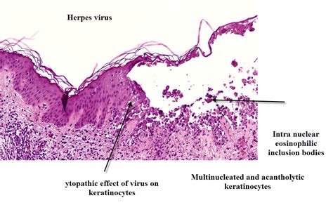 acantholysis - pictures, photos