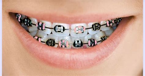 1000+ images about Braces colors on Pinterest