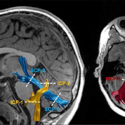 Tractography of the cerebellar peduncles. Tract renderings of the... | Download Scientific Diagram