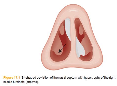 The nasal septum-17 - مدونة الدكتور حمدى زكريا الطبية