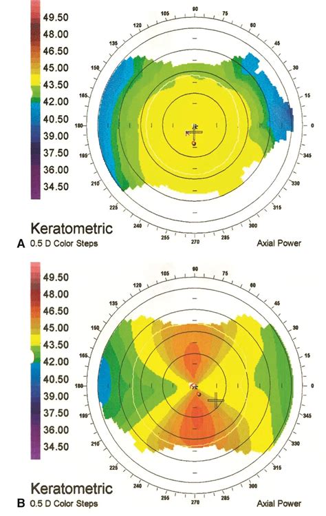 Corneal topographic patterns - American Academy of Ophthalmology