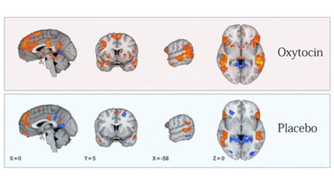 Study Shows Oxytocin Improves Brain Function in Children with Autism