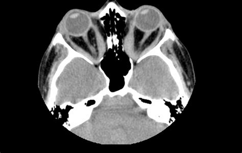 Nerve Block for Supraorbital Neuralgia Effective for Both Diagnosis and ...