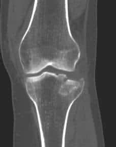 Tibial Plateau Fractures - Surgical Repair - Connecticut Orthopaedics