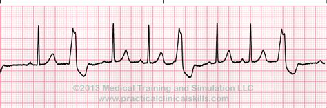 Ventricular Rhythm ECGs