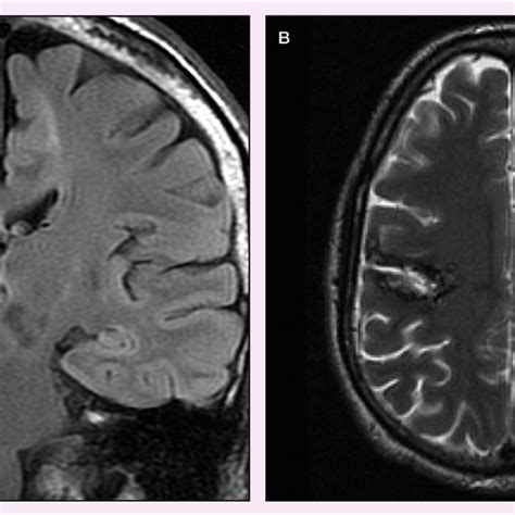 7 (A) Coronal FLAIR MRI showing focal cortical dysplasia in the... | Download Scientific Diagram