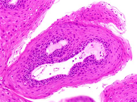 Squamous Papilloma