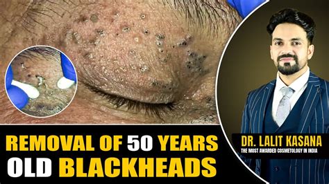 REMOVAL OF 50 YEARS OLD BLACKHEADS II Dr. Lalit Kasana's - YouTube