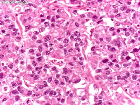 Webpathology.com: A Collection of Surgical Pathology Images