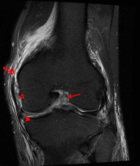 Fibular Collateral Ligament Mri