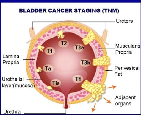 Transitional cell carcinoma Flashcards | Quizlet