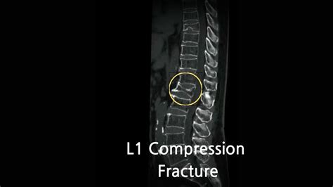 L1 Fracture - E Jurnal