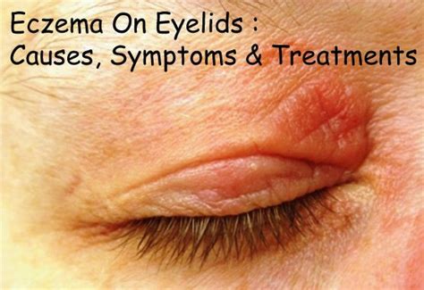 Eczema On Eyelids : Causes, Symptoms & Treatments | Disfreeskin