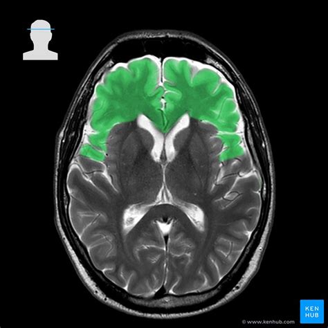 Brain Lobe Anatomy Mri