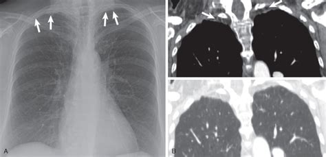 Benign Pleural Thickening | Radiology Key