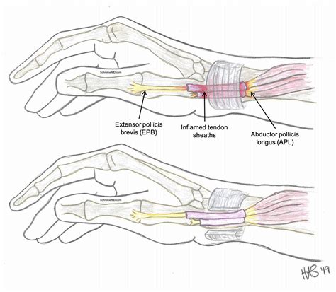 De Quervains Tendonitis