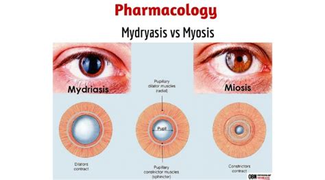 Managing Mydriasis in Cataract - IOL Surgery | OBN