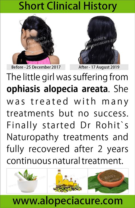 ophiasis alopecia areata treatment