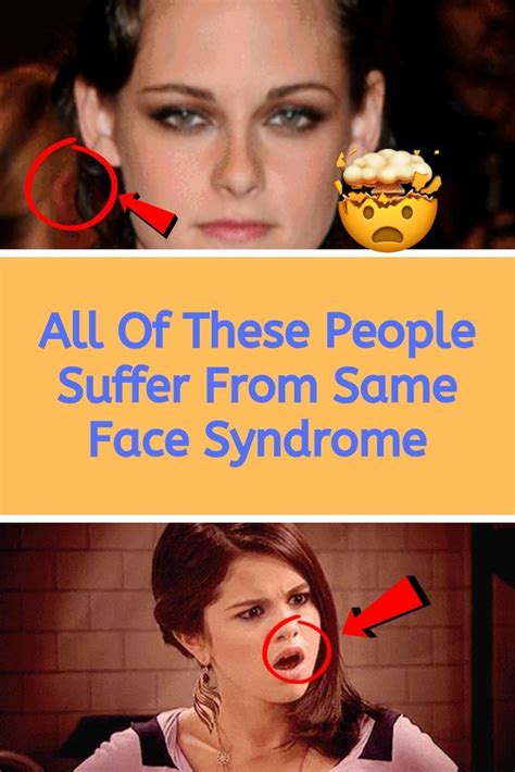 All Of These People Suffer From Same Face Syndrome | Weird facts, Weird world, Fun facts