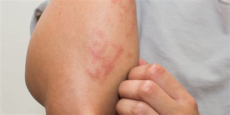 NEW in COVID-19: Skin Rashes Linked to Virus - Apex Skin