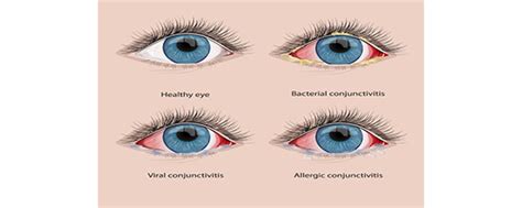 How to Care for Your Child with a Conjunctivitis | Sidra Medicine