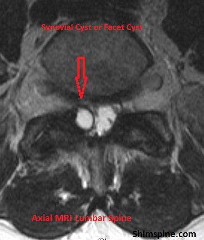 Lumbar Synovial Cysts - ShimSpine